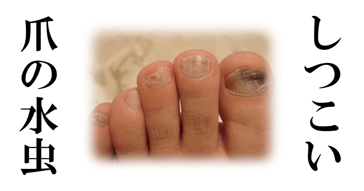 しつこい爪水虫の症状改善例 水素風呂のレンタルはbagus